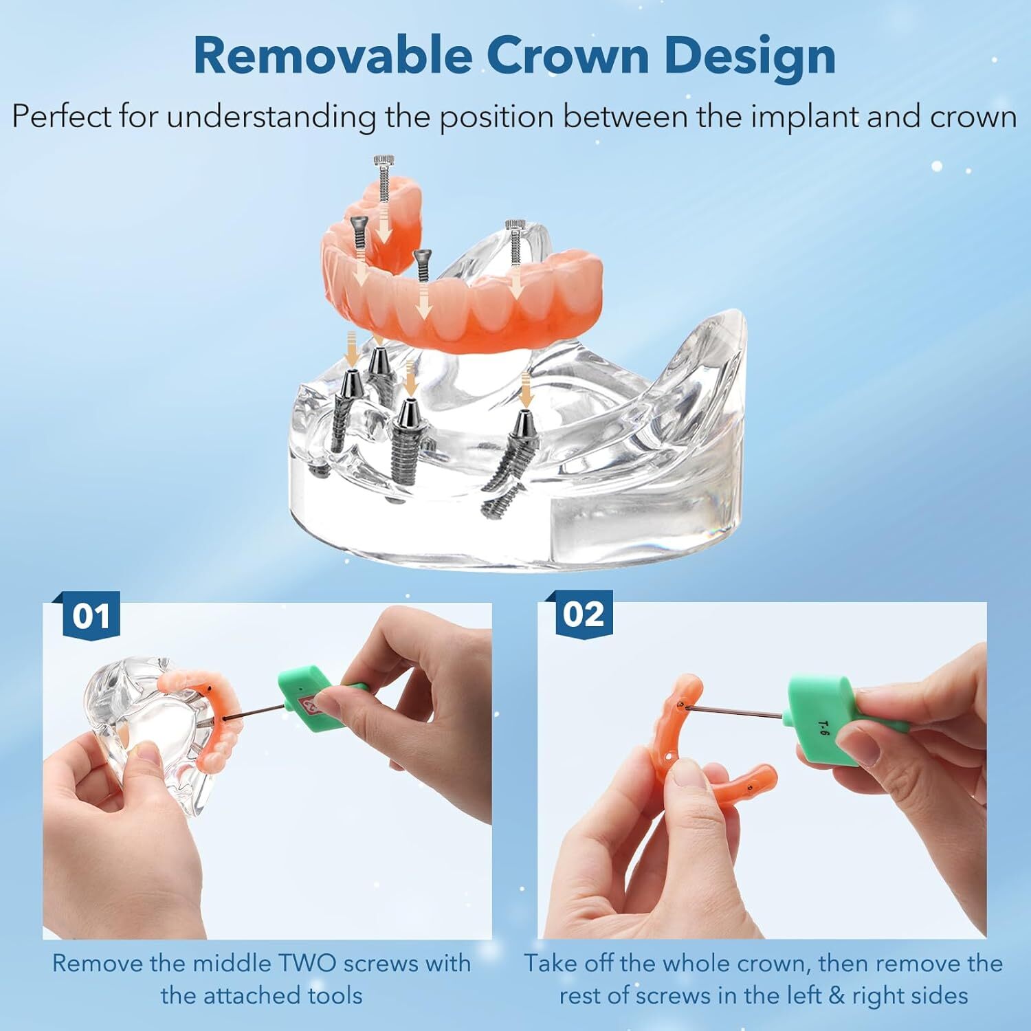 All-on-4 Dental Implants Model with Transparent Base and Removable Crown