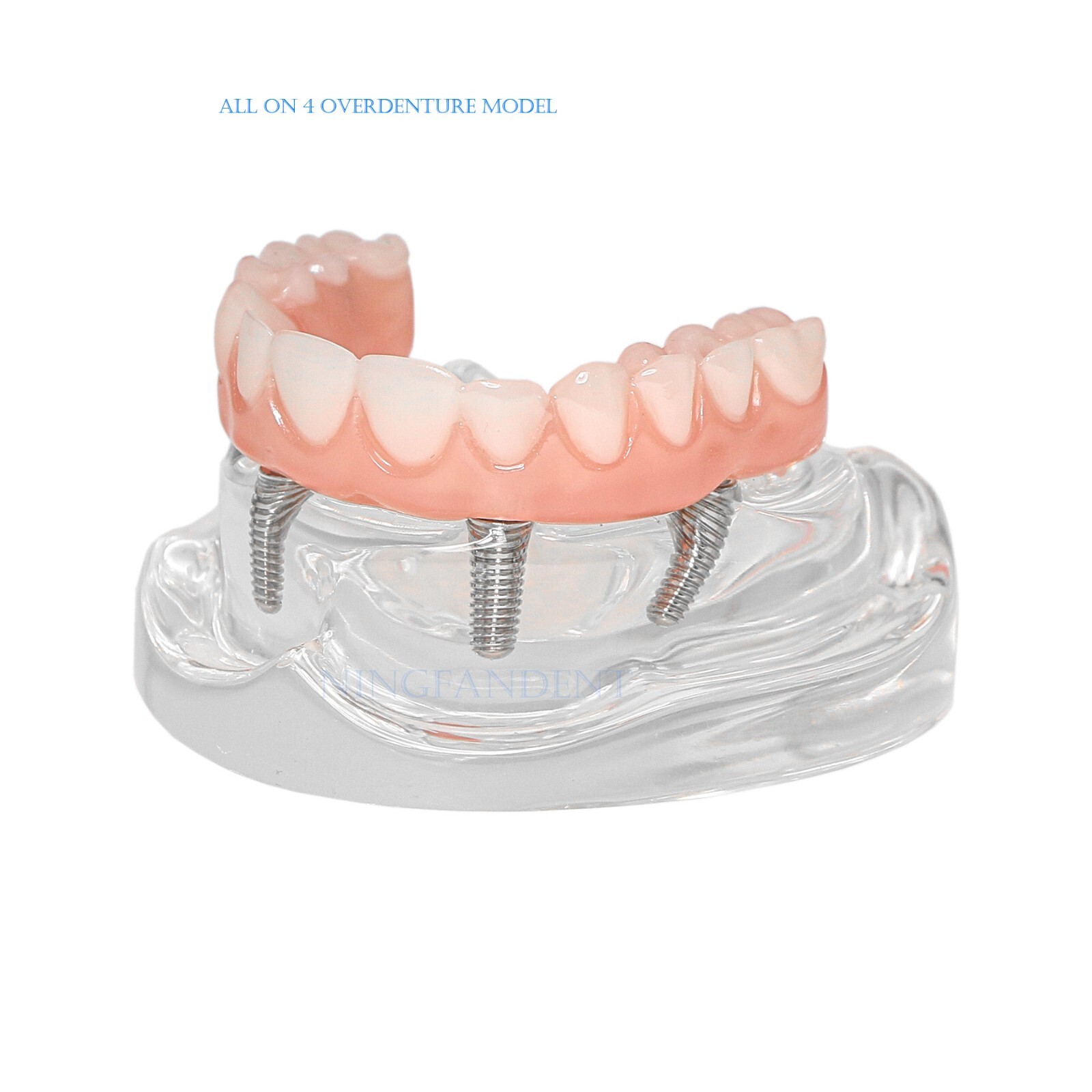 US Dental All-on-4 Overdenture treatment Implant Model Upper 4 Implants Clear