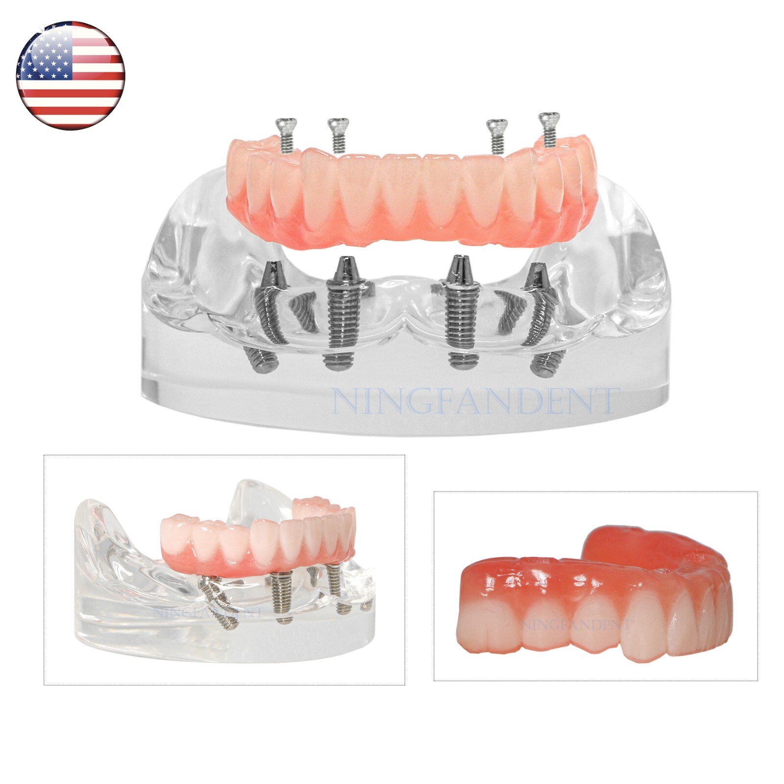 Dental Transparent Lower Jaw Malone Bridge All-on-4 Overdenture Typodont Model