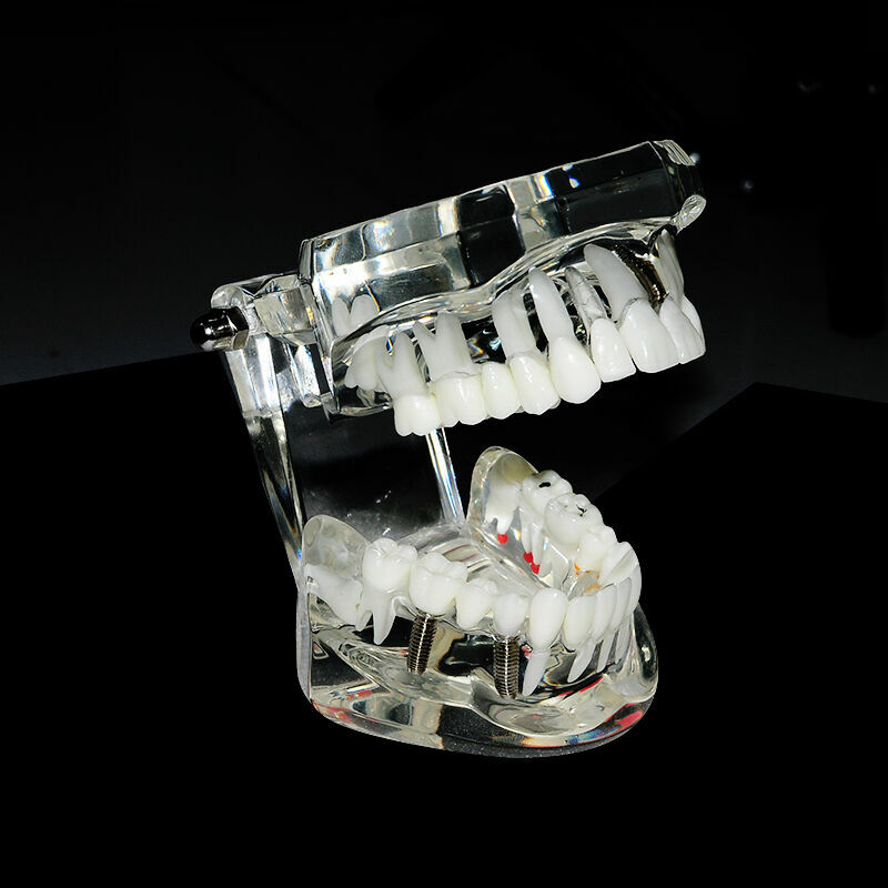 3D Dental Implant Disease Teeth Model Ortho Restoration Bridge Demo Model
