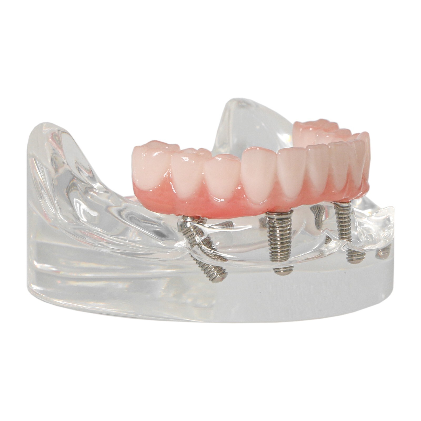 US Dental Implant Model All-on-4 All-on-6 Overdenture U/L Jaw 4/6 Screws Clear