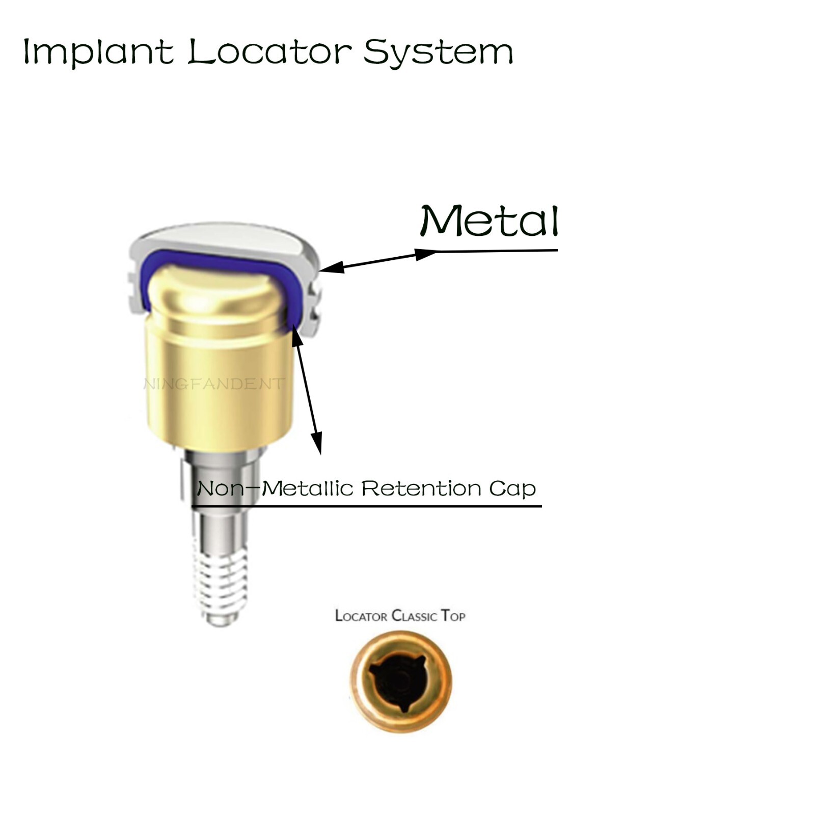 US Dental overdenture Regular locator abutment Hiossen ET fit ZEST Locator syste