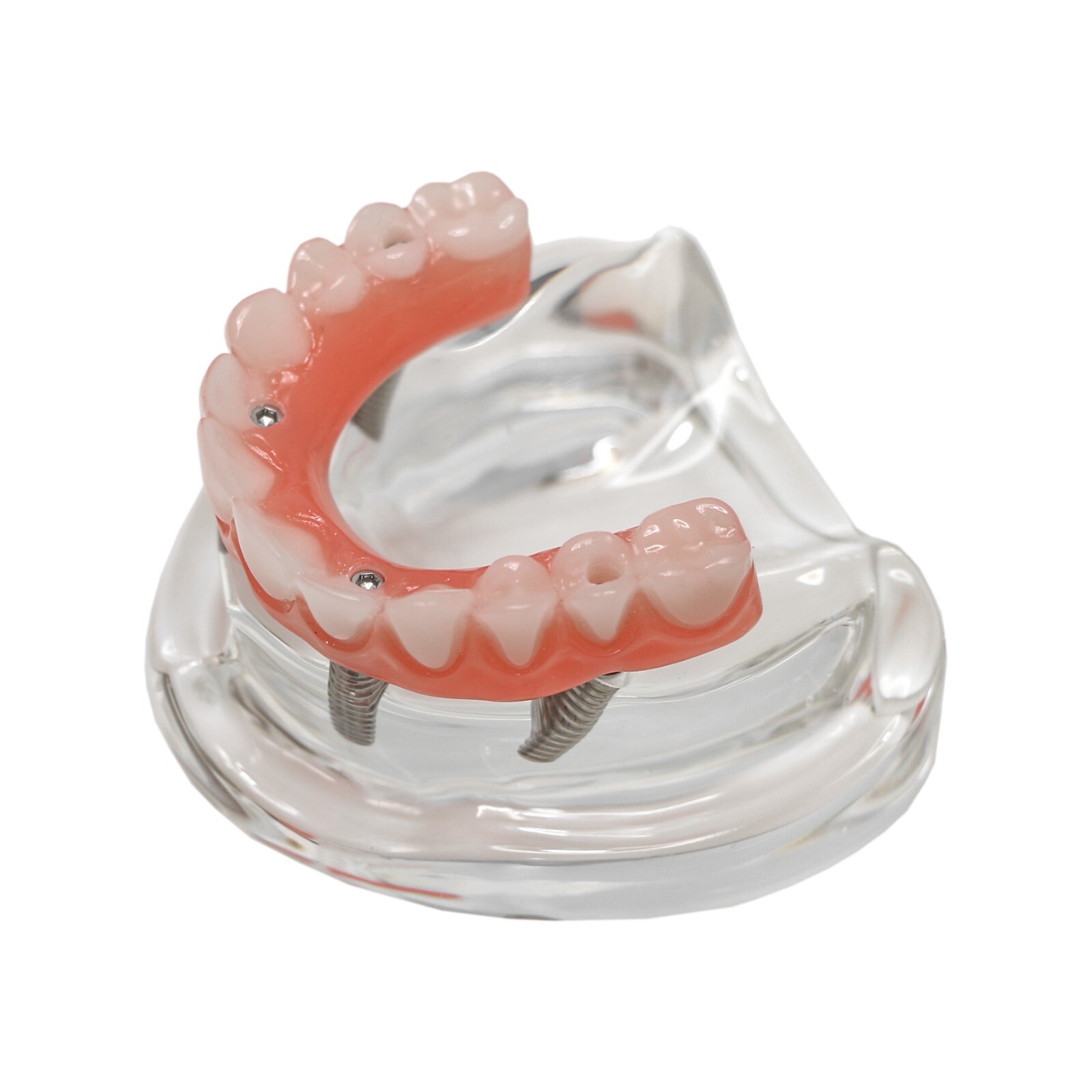 US Dental Implant Model All-on-4 All-on-6 Overdenture U/L Jaw 4/6 Screws Clear