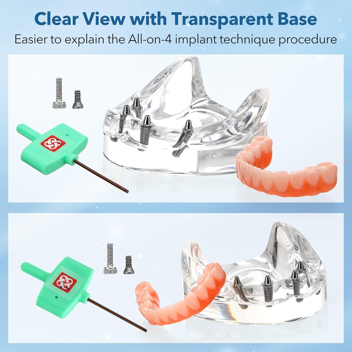 US Dental Implant Model All-on-4 All-on-6 Overdenture U/L Jaw 4/6 Screws Clear