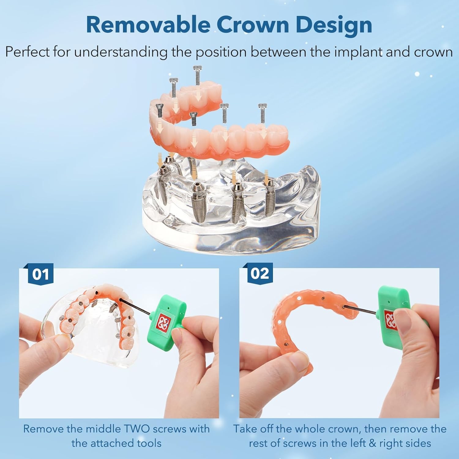 US Dental Implant Model All-on-4 All-on-6 Overdenture U/L Jaw 4/6 Screws Clear