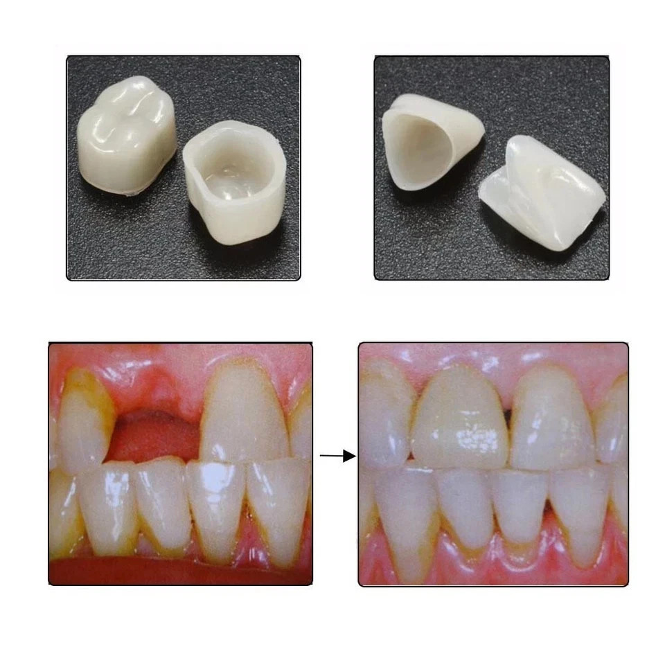 4Type Dental Temporary Crown Anterior Posterior Teeth Resin Nature Teeth Color