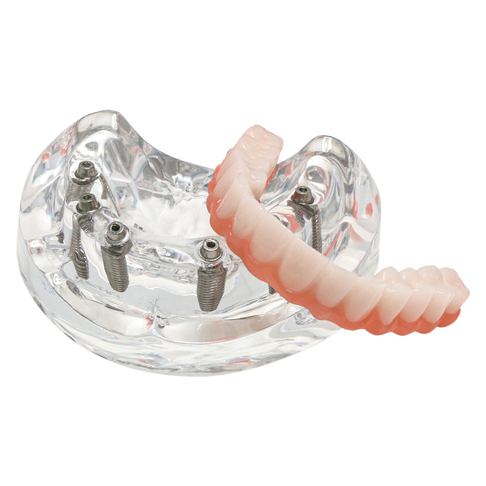 US Dental Implant Model All-on-4 All-on-6 Overdenture U/L Jaw 4/6 Screws Clear