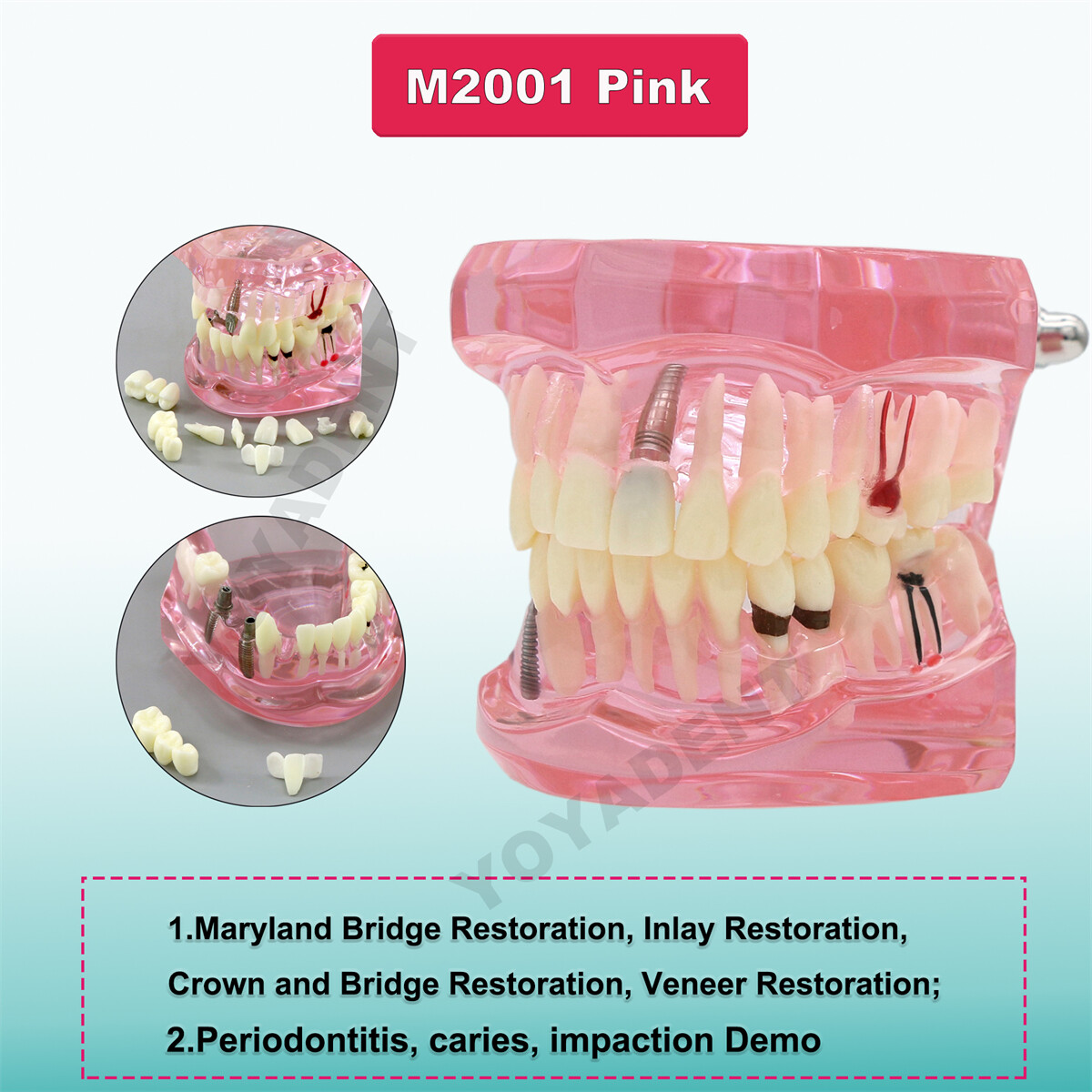 US Dental Typodont Teeth Model Implant Restoration Orthodontics Demo Teaching