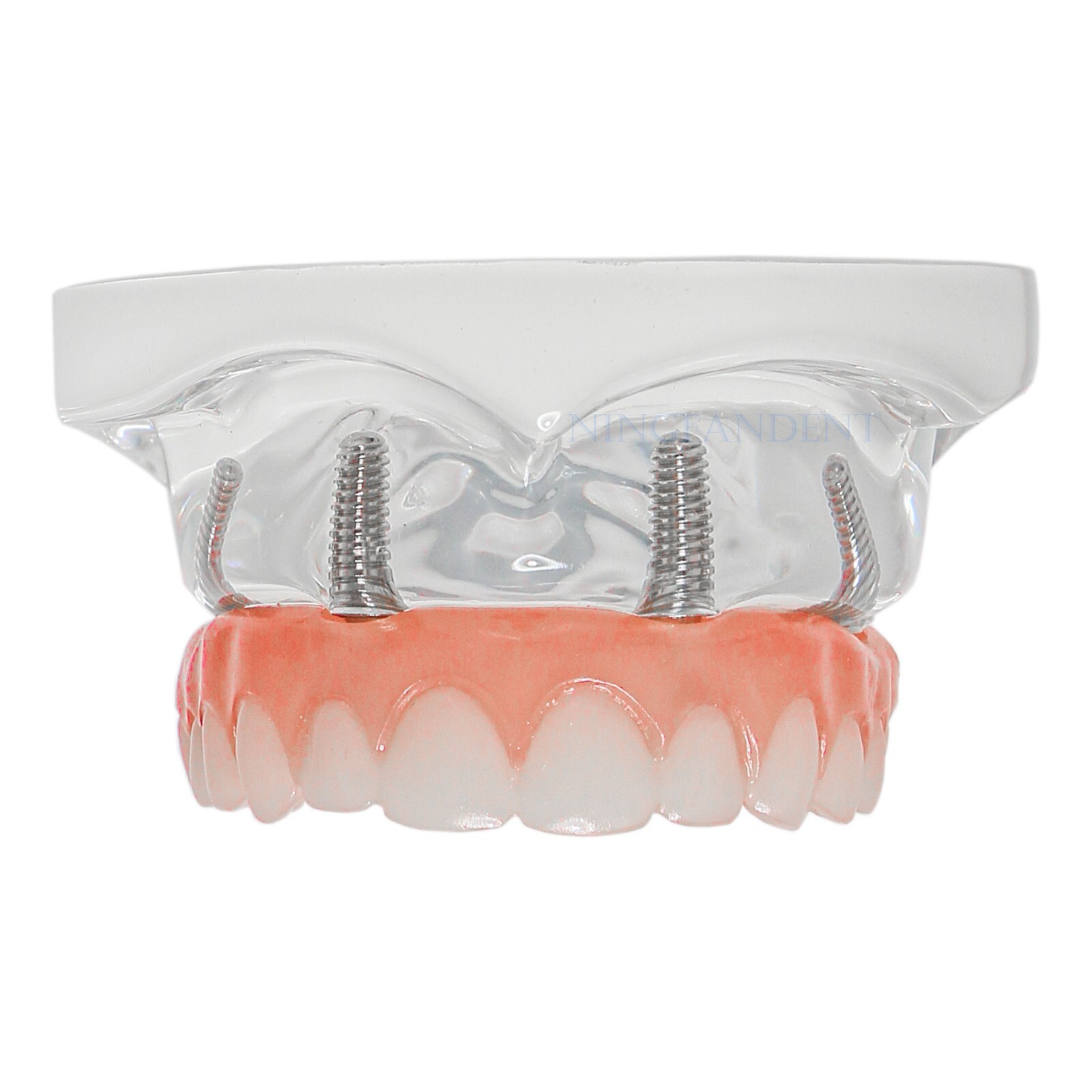 US Dental All-on-4 Overdenture treatment Implant Model Upper 4 Implants Clear