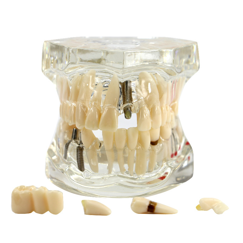 3D Dental Implant Disease Teeth Model Ortho Restoration Bridge Demo Model