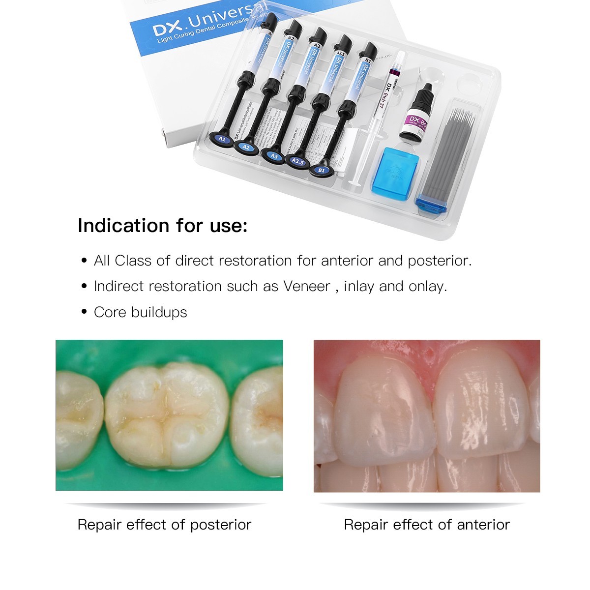 Dentex Dental Universal Composite Resin Light Cure A1 A2 A3 A3.5 B1 Kit