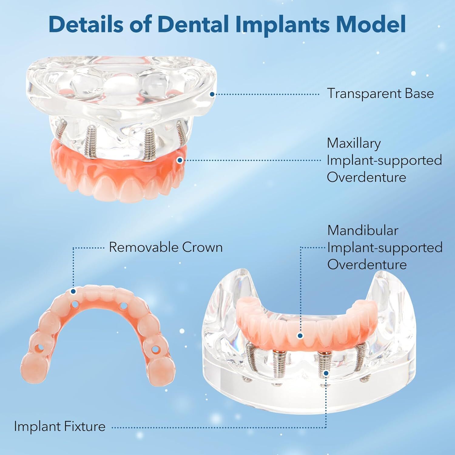 US Dental Overdenture Implant All-on-4 Upper/Lower Clear Jaw Model With 4 Screws